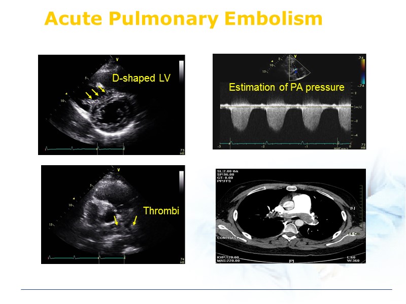 Acute Pulmonary Embolism D-shaped LV Thrombi
